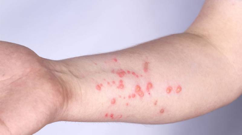 Monkeypox In Pakistan: Do You Need To Be Worried?