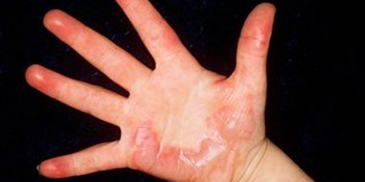 Man Puts Minor’s Hand In Hot Oil Pan For Refusing To Wash Dishes